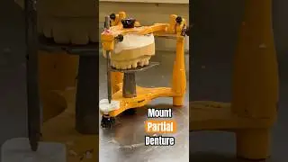Partial Denture Cast ✨ Quick Mounting on Articulator #Prosthodontics#PartialDenture#Articulator