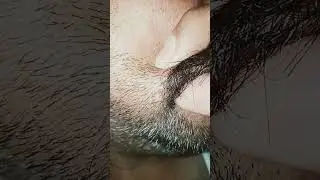 #satisfying #bug #hairproblem #hairissue #ingrownhairremoval #relax #ingrownhair#pimple #extraction