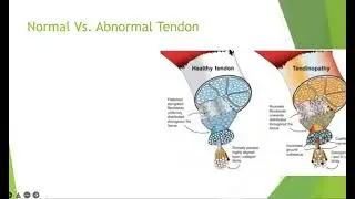 Tendinopathy Workshop with Chris Gettle, DPT, OCS
