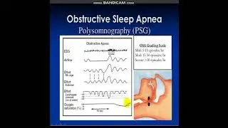 #polysomnography#
