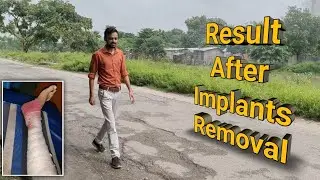 tibia fibula fracture recovery | Result After Implants Removal