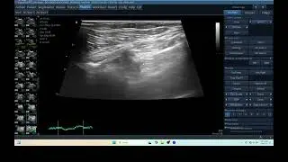IQ 215 LEFT MIDDLE LOBE MASS LUNG ULTRASOUND ECHOPAC ANALYSIS HEART WORM DISEASE HARD