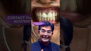 metal free caps |tooth matching caps |best hospital for Cosmatic caps
