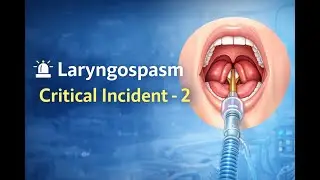 Laryngospasm  A Clinical Guide / Anaesthesia review Hub