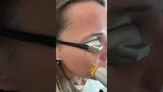 Лазер сосудистых звездочек, красных точек, вен розацеа L&aacute;ser VASCULAR ara&ntilde;as vasculares puntos rojos