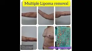 Multiple Lipoma removal #lipoma #drsanjibtripathee #plasticsurgery #cosmeticsurgery