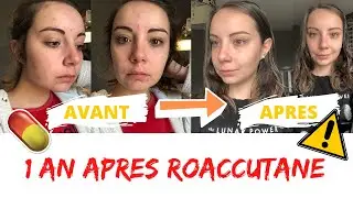 BILAN 1 AN APRES ROACCUTUANE (ACNE,CICATRICE, MON AVIS&hellip;)