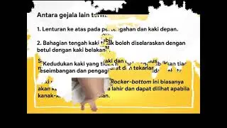 Sono Ultrasound : Rocker Bottom foot
