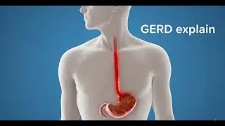 GERD Explained: Heartburn, Acid Reflux & Chronic Cough | Causes, Symptoms & Management