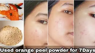 I used orange peel powder to clear my acne marks ||Before & after results