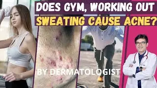 Does Working Out Cause Acne ? Does Gym Cause Acne ? Does Sweat Cause Acne, Pimple on Back, Face