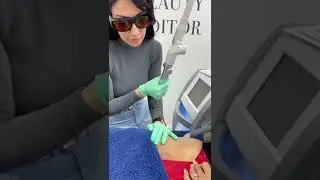 Laser Tattoo Removal Bikini