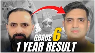Best Hair Transplant Result 2022 | Grey hairs | Grade 6 Baldness | Diffuse Pattern | QHT Clinic