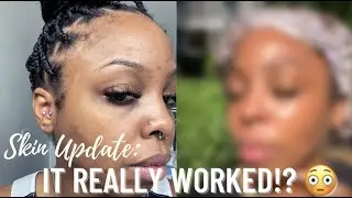 Skin update | TULA Skincare + Dr.Dennis Alpha Beta Peel + SPF 30