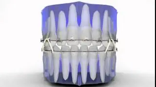 Fastbraces&reg; Technology: Openbite