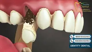 Complete Plaque & Tartar Removal | Deep Dental Cleaning at Dentity Dental | Transform Your Smile