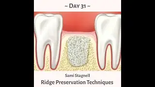 90 Day Dental Day 31- Sami Stagnall- Ridge Preservation Techniques