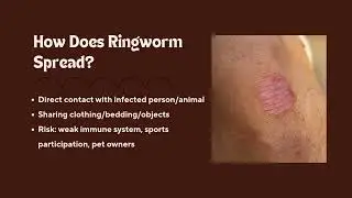 Ringworm