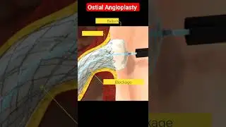 Angioplasty (Animation) l Ostial Stenting l RCA l #angioplasty #shorts