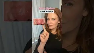 Wszystko o Rhinophyma #rhinophyma #rosacea