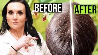 How to Get Rid of Lice FAST!! 1 Hour Lice Treatment!