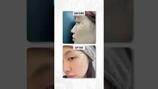 Cryotherapy for skin lesions part 1 #shorts