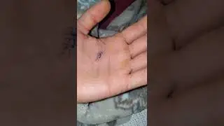 Removing stitches