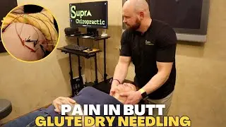 Dry Needling For The Gluteal Muscles *TIGHT CRACKS*