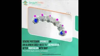 Deprogramming Settling Invisalign with MA Cases or Posterior Openbite Cases with CR-CO Shift