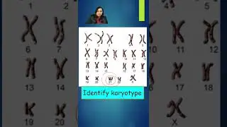 Karyotype Of Down Syndrome Pediatrics - Image based Diagnosis, OSCE, Spot  - Shorts