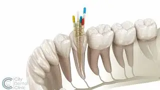 Endodontie | Wurzelbehandlung | City Dental Clinic Bratislava