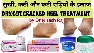 Cracked heel ka ilaz...फटी एड़ियों के इलाज #drniteshraj best cream how to choose heel crack