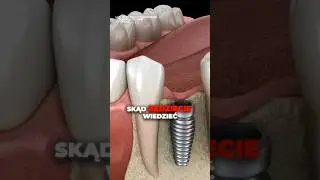 IMPLANT SIĘ NIE PRZYJĄŁ, a TY NIC NIE CZUJESZ? 😱🦷 Dentysta: CZĘSTO DOWIADUJESZ SIĘ... PRZYPADKIEM!