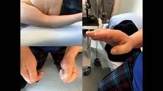 CRPS after Lower Motor Neuron Injury. Maddie WIlton-Clark
