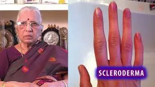 Scleroderma Treatment | Dr.P.S Lalitha | Drugless Therapy | Reiki Treatment