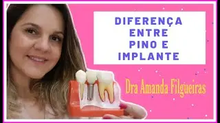 Qual a diferença ente pino + coroa e implante dentário?