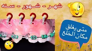 تقويم الأسنان |متى و كيف يغلق مكان خلع الأسنان | تفاصيل هامه جدا 🌸✅