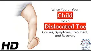 Toe Injuries: How to Handle a Dislocated Toe with Care