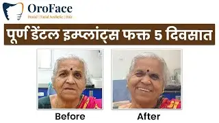 Full Dental Implants Sirf 5 Din Mein? Real Patient Transformation!