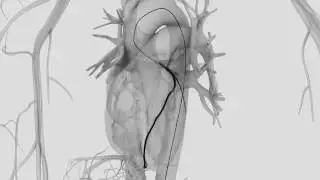 Asian Heart Hospital - How is Coronary Angiography Performed?
