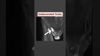 Undescended Testis MRI #shorts #viral #youtubeshorts #mrincredible
