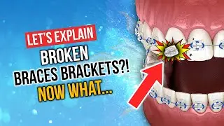 Broken Braces?!! - What you should do with broken brackets...