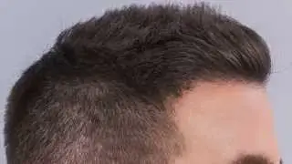 3500 FUE Hair Graft Results – Dr. Baubac Hayatdavoudi | Los Angeles, CA
