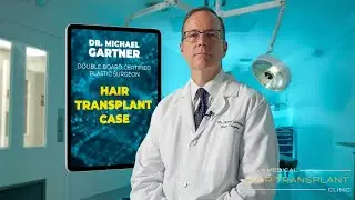 Hair Transplant Patient Case: 3000 Graft FUE | Gartner Plastic Surgery