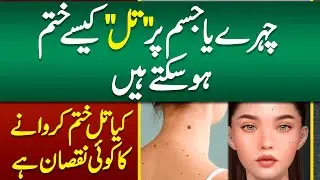 Which is Best Mole Treatment Laser or Surgery? Facial and Large Mole Removal Treatment - Til ka ilaj