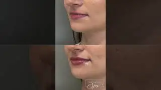 Lip Flip + Filler: Level Up Your Lips with This Combo at The Memorial Spa!
