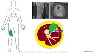 Soft Tissue Sarcoma