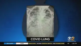 Doctors: Asymptomatic COVID Cases Can Still Damage Lungs