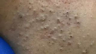 [ASMR] Глубокое очищение лица, выдавливание прыщей и удаление черных точек