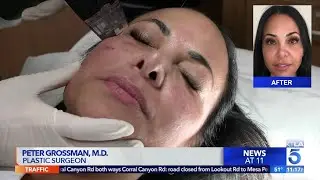 Morpheus8 Microneedling & Radiofrequency In Beverly Hills